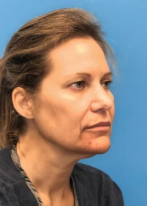 Facelift-Case--18078 | Before Dr. Samir Rao 2