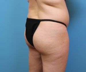 Brazilian-Butt-Lift-Case--266 | Before Body 1