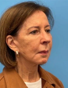 Facelift-Case--25941 | Before Face 2