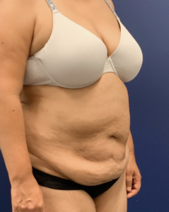 Liposuction-Abdominoplasty-Case--25576 | Before Liposuction 2