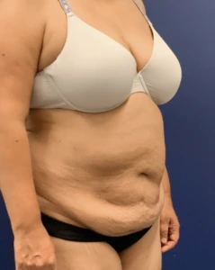 Liposuction-Abdominoplasty-Case--25576 | Before Body 2