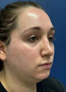 Submental-Liposuction-Case--29107 | Before Face 2