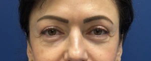 Lower-Blepharoplasty-Case--26939 | Before Dr. Samir Rao 2