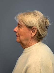 Facelift-360-Facial-Fat-Grafting-and-Necklift-Blepharoplasty-Case--1088 | After Dr. Arjun Kanuri 2