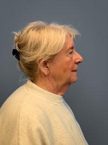 Facelift-360-Facial-Fat-Grafting-and-Necklift-Blepharoplasty-Case--1088 | Before Dr. Arjun Kanuri 2