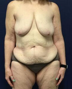 Abdominoplasty-Case--7412 | Before Dr. Frank Albino 1