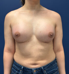 Breast-Augmentation-Case--2719 | After Breast Augmentation 1