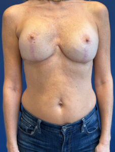 Breast-Reconstruction-Case--8978 | After Dr. Frank Albino 1