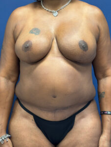 Breast-Reduction-Case--4053 | After Dr. Frank Albino 1