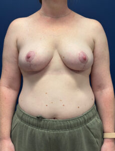 Breast-Reduction-Case--2959 | After Dr. Frank Albino 1