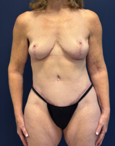Abdominoplasty-Case--7412 | After Dr. Frank Albino 1