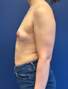 Breast-Augmentation-Case--2719 | Before Breast Augmentation 2