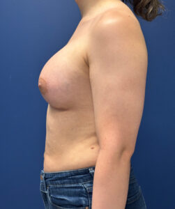 Breast-Augmentation-Case--2719 | After Breast Augmentation 2