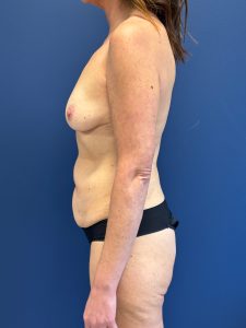 Abdominoplasty-Case--2448 | Before Body 2