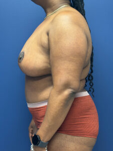 Abdominoplasty-Case--5907 | After Dr. Frank Albino 2