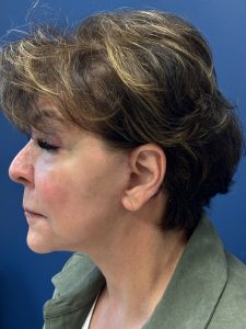 Facelift-Case--6613 | After Face 2