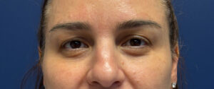 Blepharoplasty-Case--5118 | Before Eyelid Surgery 1