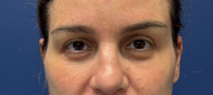 Blepharoplasty-Case--5118 | After Eyelid Surgery 1