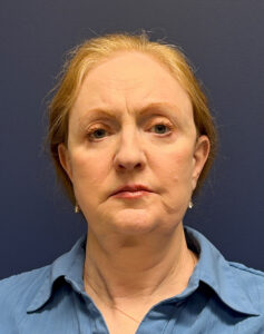 Facial-Fat-Grafting-Case--3549 | After Facial Fat Grafting 1