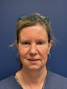 Facelift-Case--2304 | Before Face 1