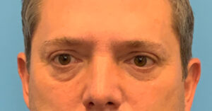 Blepharoplasty-Case--5888 | Before Dr. Frank Albino 1