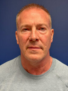 Facelift-Case--5246 | Before Facelift 1