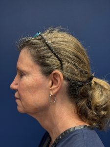 Facelift-Case--2304 | Before Face 2