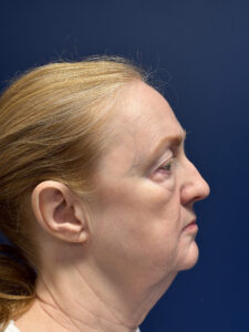 Facial-Fat-Grafting-Case--3549 | Before Facial Fat Grafting 2