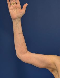 Brachioplasty-Case--3625 | After Body 2