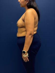 Left-Oncoplastic-Right-Reduction-Breast-Reconstruction-Case--9659 | After Dr. Samir Rao 2