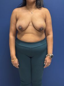 Left-Oncoplastic-Right-Reduction-Breast-Reconstruction-Case--9659 | Before Dr. Samir Rao 1
