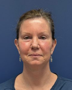 Facelift-Case--2304 | After Face 1