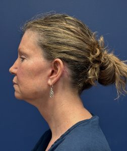 Facelift-Case--2304 | After Face 2