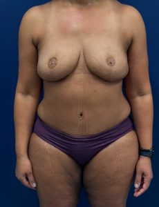 Bilateral-DIEP-Flap-Case--2073 | After DIEP Flap 1