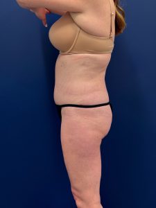 Abdominoplasty-Case--1715 | After Tummy Tuck 2