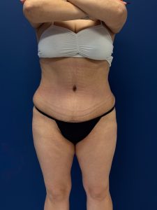 Abdominoplasty-Case--7989 | After Tummy Tuck 1