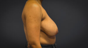 Breast-Reduction-Case--7089 | Before Breast Reduction 2