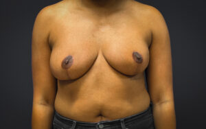 Breast-Reduction-Case--7089 | After Breast Reduction 1