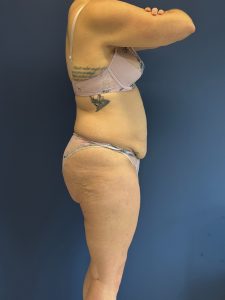 Abdominoplasty-Case--1856 | Before Tummy Tuck 2