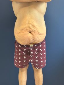 Body-Lift-Case--1927 | Before Body Lift 1