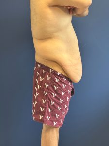 Body-Lift-Case--1927 | Before Body Lift 2