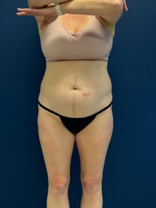 Abdominoplasty-Case--1715 | Before Tummy Tuck 1