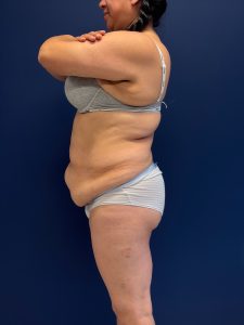 Abdominoplasty-Case--7989 | Before Tummy Tuck 2