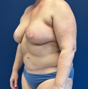 DIEP-Flap-Case--1682 | After DIEP Flap 2