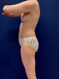 Abdominoplasty-Case--4180 | After Dr. Samir Rao 2