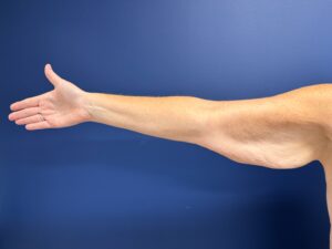 Brachioplasty-Case--3898 | Before Arm Lift 1