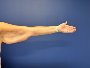 Brachioplasty-Case--3898 | Before Arm Lift 2