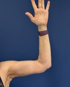 Brachioplasty-Case--3625 | After Body 1