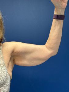 Brachioplasty-Case--3625 | Before Body 1