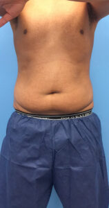 Lipo-360-Case--4979 | Before Liposuction 1